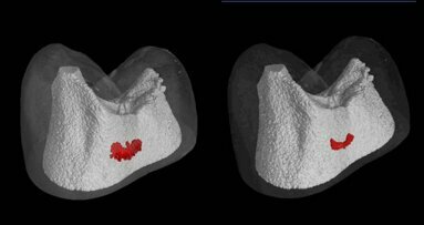 New device to treat caries with electric remineralisation
