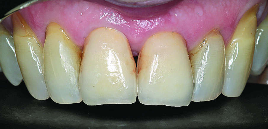 Slike 11 i 12. Definitivna protetska opskrba zubi 11 i 21: cirkonij-oksidne krunice na titanijskim bazama. 