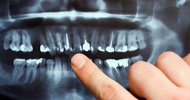 Stan zębów a zdrowie zatok