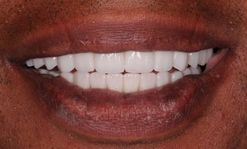 Fig. 27: Frontal view of the patient’s smile, showing improved aesthetics and function.