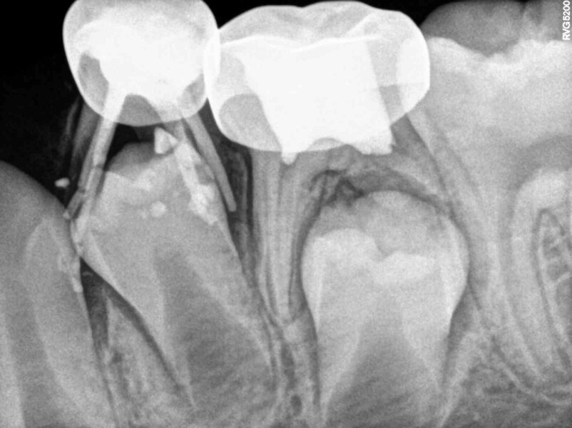Fig. 8 : Contrôle à 14 mois montrant l’évolution normale du processus éruptif des dents permanentes remplaçantes. 