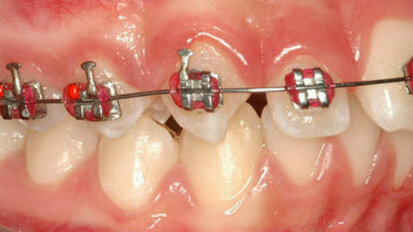 Alerta sobre aplicação ilegal de aparelhos dentários