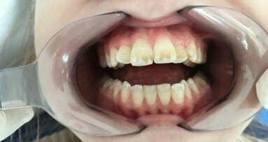 Stan zdrowia jamy ustnej u chorych na mukowiscydozę – przegląd literatury