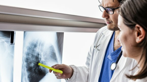 Dentisti sviluppano un test della saliva per la diagnosi precoce del cancro al polmone