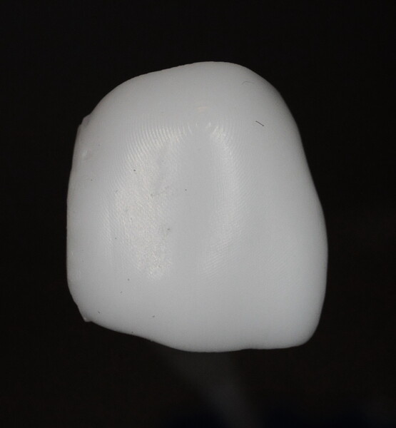 Fig. 8: 3D-printed crown for tooth #11, facial view.