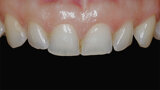 Fig. 1. Fotografía inicial de los dientes anteriores antes del tratamiento de ortodoncia.