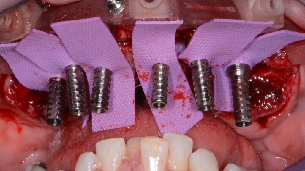 Predictable immediate guided implant placement and provisionalisation