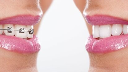 Tuchtcollege geeft tandarts-orthodontist tik op vingers
