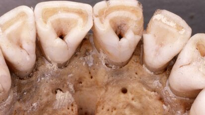 Genetic mutation from last ice age linked to shovel-shaped incisors