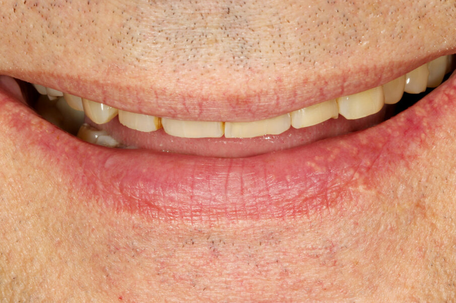 Fig. 1: Pronounced abrasion due to bruxism, resulting in significant loss of the vertical dimension.