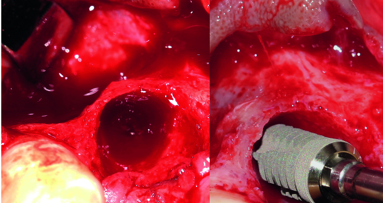 Localized ridge augmentation utilising titanium mesh with CPS morsels and simultaneous implant placement—A case report