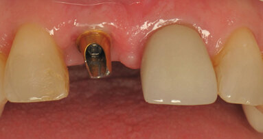 The Hiossen ETIII Implant System: A coordinated approach to esthetic restorations