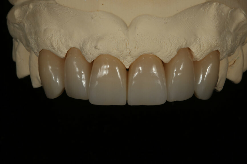 Fig. 5: Final restorations with a natural appearance. The effects created with Esthetic Colorant shine from deep within the restorations.