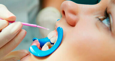 Nella prevenzione della carie, i sigillanti dentali a confronto con le vernici al fluoro