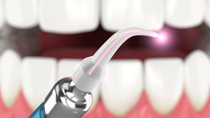 Lasery v ortodoncii: Zlepšení kvality péče a úspora času díky ošetření laserem