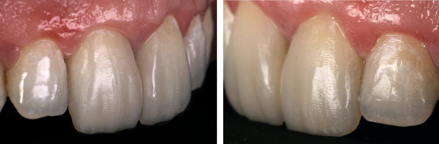 Fig. 17a & 17b: Old composite fillings on tooth # 12 & 22 were replaced  during the recall visit with Class III Direct composite restorations using the same layering technique with the Beautifil range of bioactive composites.