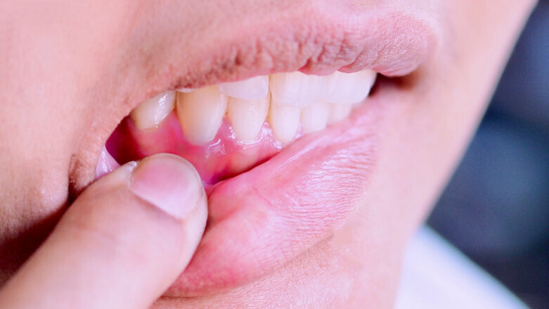 New study explains link between obesity and periodontal disease