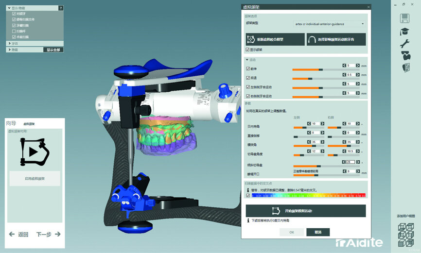 Fig. 36: The incisal guide table was set
in the virtual articulator.