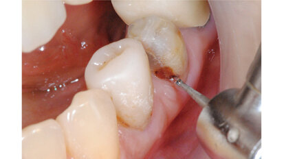 歯髄保護