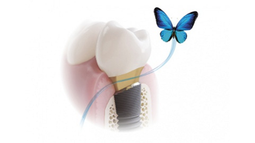 Dentsply Sirona – OsseoSpeed Profile EV