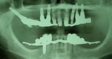 Caso clinico di odontoiatria forense relativo a un piano riabilitativo complesso implantare