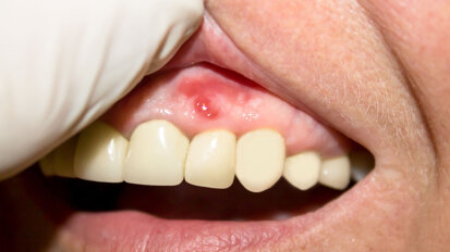 Research identifies potential novel treatment for managing periodontal disease