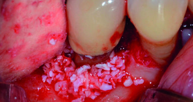 Rigenerazione Tissutale Guidata (G.T.R.) di un difetto intraosseo circonferenziale: caso clinico