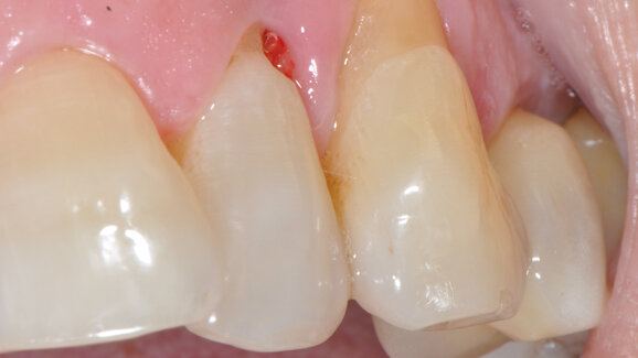 Utilizzo di metronidazolo topico nel trattamento  di siti con parodontite severa e perimplantite