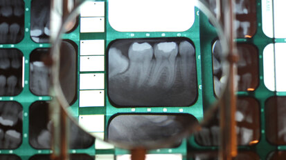A inteligência artificial mostra-se promissora para detectar o estado periodontal em radiografias interproximais