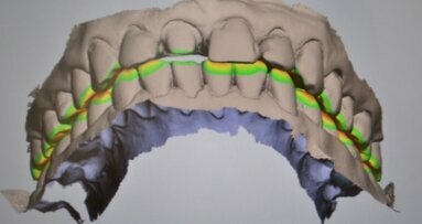 Zastosowanie skanera wewnątrzustnego w praktyce dentystycznej