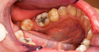 Europese Commissie adviseert verbod op tandheelkundig amalgaam