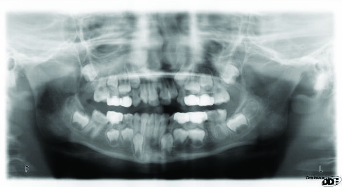 Figure 1:  A panoramic radiograph showing ectopically erupted upper right and lower right first permanent molars.