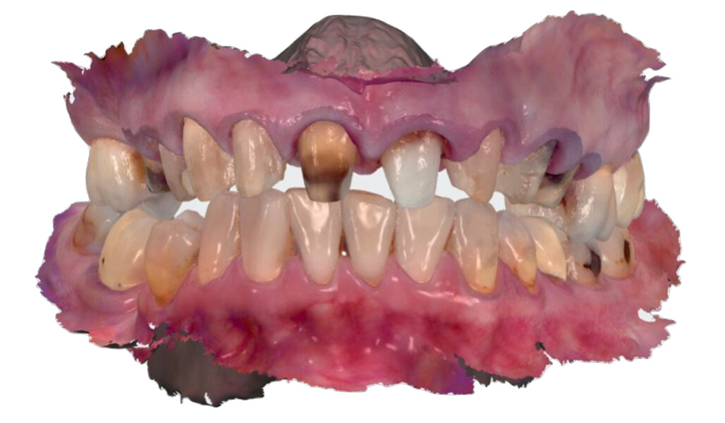 Fig. 7: Digital impression taken after tooth preparation.