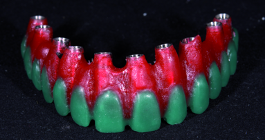 Contribution of CAD/CAM technology to implant-supported screw-retained restorations