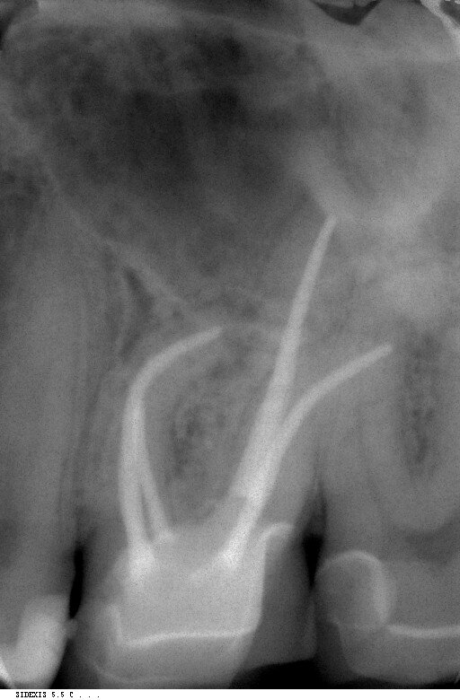 Fig. 8: Radiographic follow-up after six years.