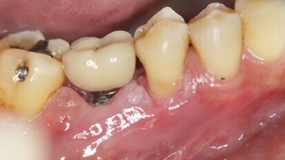 Peri-implantitis je druga najčešća komplikacija nakon terapije zubnim implantatom