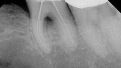 An endodontic absurdity
