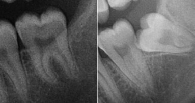 Importance of a preoperative radiographic scale for evaluating surgical difficulty of impacted mandibular third molar extraction