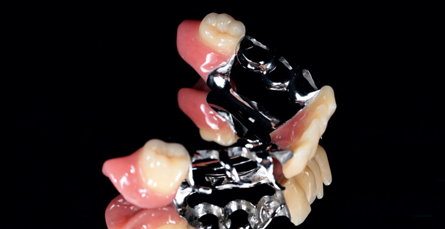 Fig: 9. Model cast denture in the lower jaw with an open periodontal design (self-cleansing).