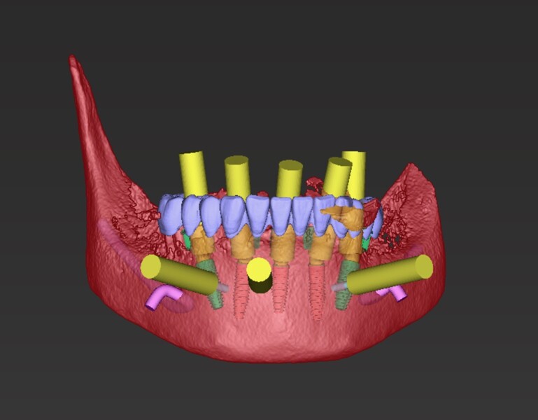 Fig. 15: Mandibular surgical treatment planning with the mandibular prosthesis using coDiagnostiX.