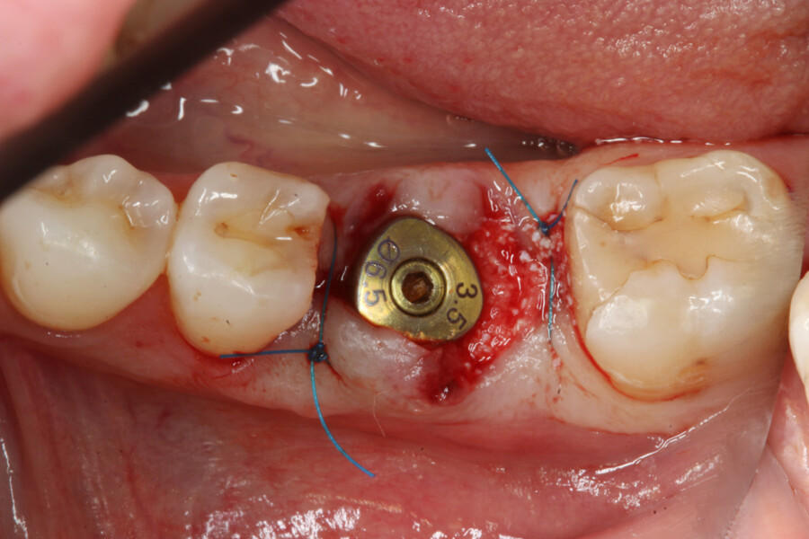 Fig. 7: Socket grafted with Symbios and healing abutment placed. 