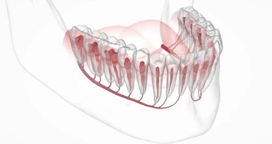 Umělá inteligence může být nápomocná při zavádění dentálních implantátů v lokalizaci mandibulárních kanálů