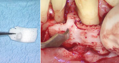 Tessuto dentale stampato in 3D: primo caso di fallimento a lungo termine