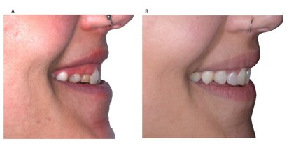 Piano di trattamento digitale in un caso di agenesia dentale multipla anteriore