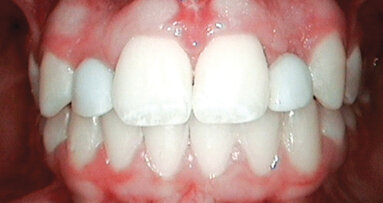 Replacing congenitally missing lateral incisors