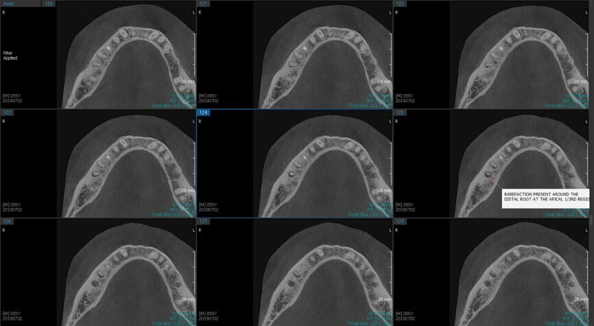 Fig.2e: Pre-op CBCT images of tooth #46: No obturation material in the distal and mesiobuccal canal (a); scanty obturation of the canals and breach of the floor of the pulp chamber, no obturation beyond a few millimetres down the orifice (b & c); radiolucency in the furcation area and periapical region of both roots (d -g).