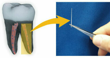 Sperimentati dagli scienziati nuovi biomateriali a base di “microdiamanti” per la terapia canalare