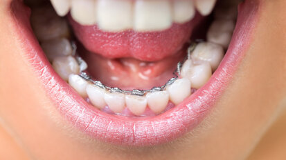 Study finds Saudi Arabians prefer lingual brackets and clear aligners