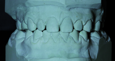 Interdisciplinary treatment of a patient with 11 missing permanent teeth: A biomimetic approach