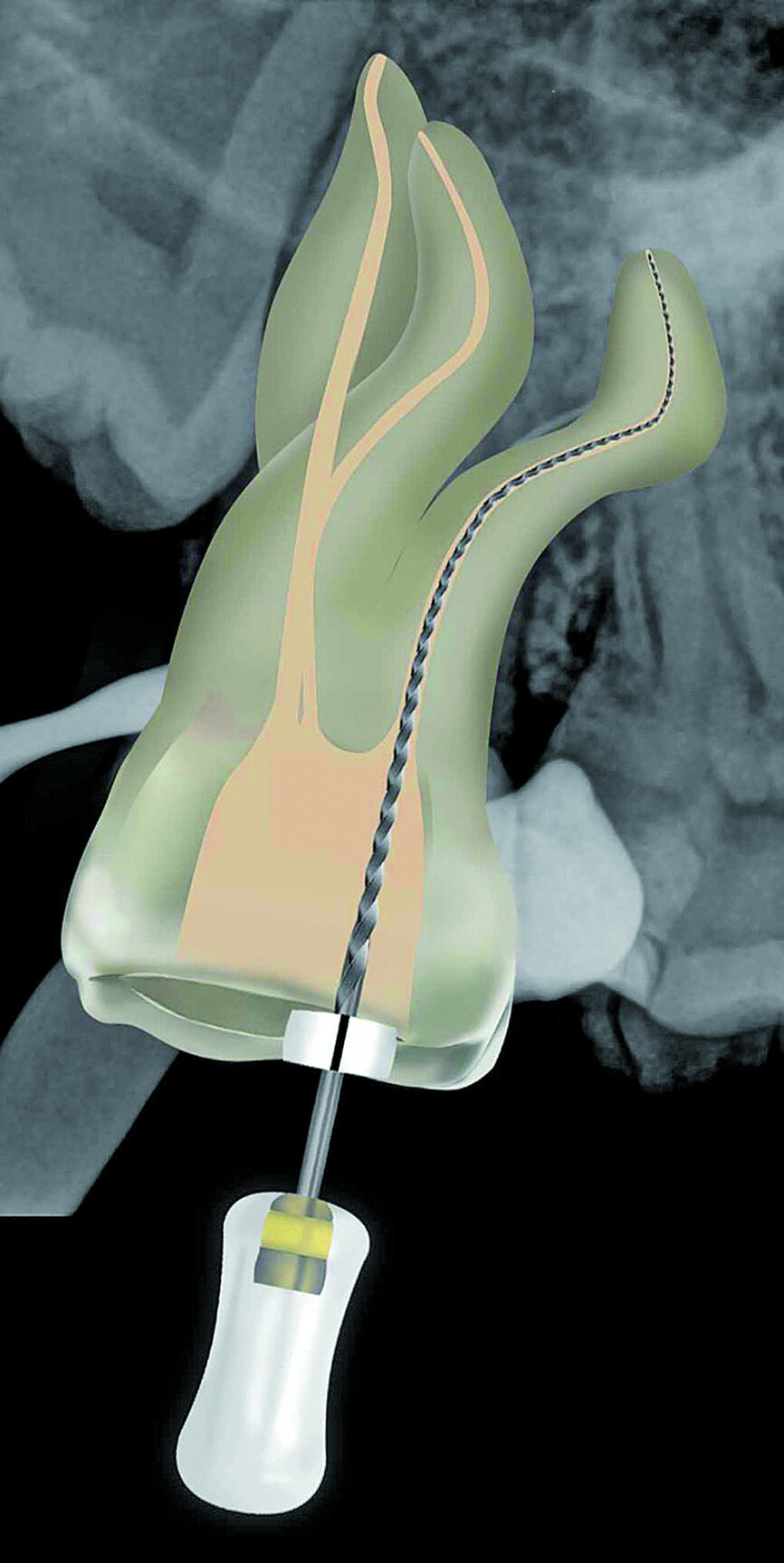 Fig. 24: A ProGlider, converted to a manual file, was used to expand the glide paths in the two buccal root canals.